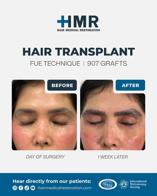 Don't wait until it is too late to get your desired look; 907 grafts and a major change one week lat