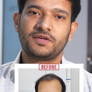 From Bald to Bold. 💪✨
Watch real patients beat baldness and transform their look with Panacea Globa