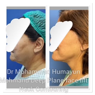 Deep Plane Facelift with Neck and jawline contouring . #facelifting #cosmeticsurgery #neckcountourin