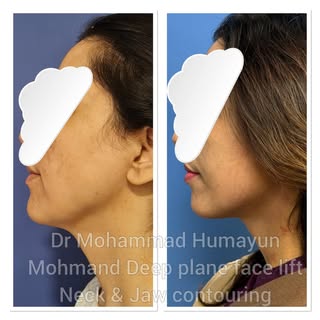 Deep Plane Facelift with Neck and jawline contouring . #facelifting #cosmeticsurgery #neckcountourin