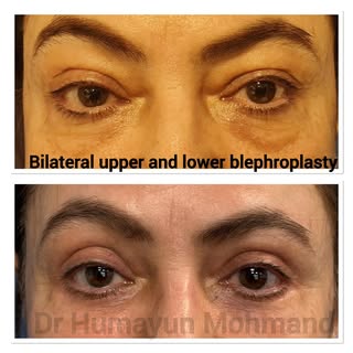 Upper and lower lid blephroplasty through a mid face lift approach #cosmeticsurgeon #cosmeticsurgery