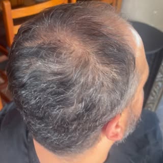 Rejuvenesça 10 anos! #protesecapilarmasculina WhatsApp 19 99669-5539