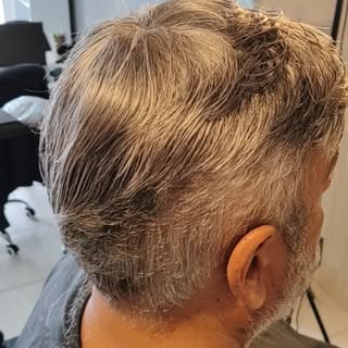 Prótese Capilar! 19 9.9669-5539