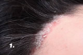 Psoriasis and eczema can look similar—but they’re not the same 👀

✨ Psoriasis
• Autoimmune conditio