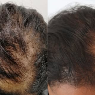 Just After 3 Treatments - Look at the Results!

Don’t wait any longer to start your hair restoration