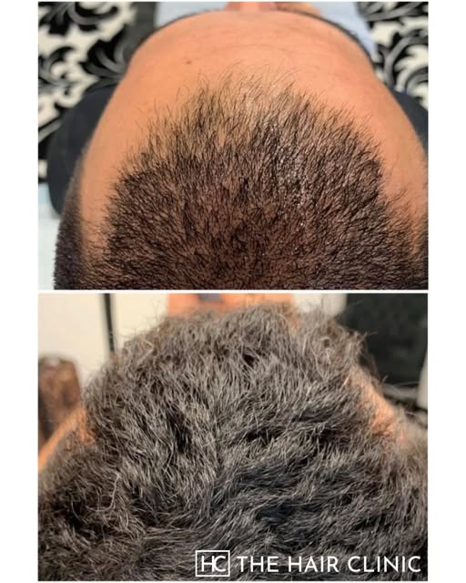 This before & after shows one patient’s hair journey following a course of PRP at The Hair Clinic.

