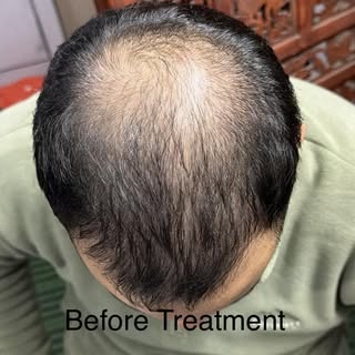 Hair Transplant is not always the right answer to hair loss. This person came for Hair Transplant an