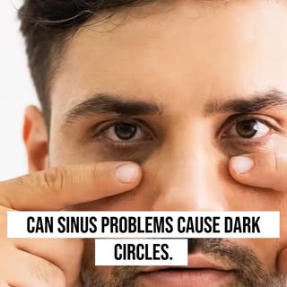 Did you know your dark circles could be linked to sinus problems? 👀

Inflamed sinuses can cause the