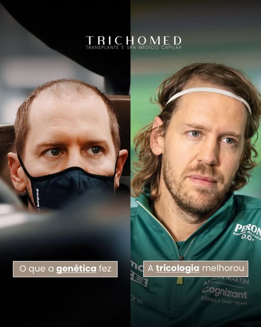 A queda de cabelo, especialmente a calvície genética, pode impactar a autoestima e a maneira como mu