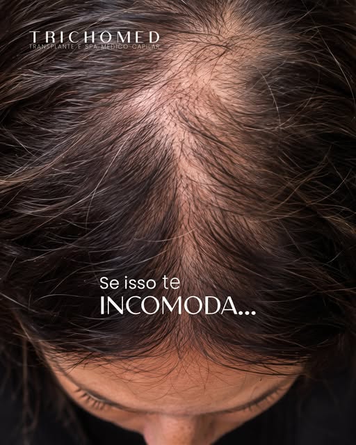 A calvície pode causar um incômodo que vai além da perda dos fios, afetando a autoestima e a confian
