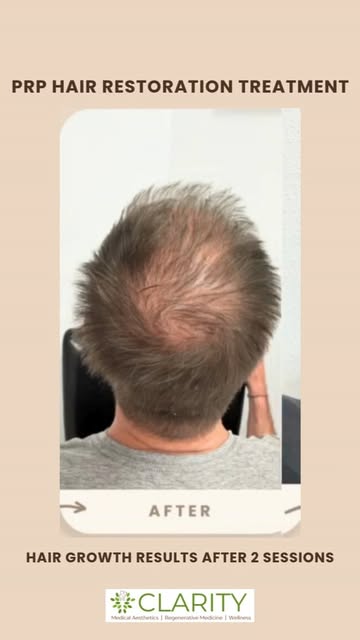 Struggling with thinning hair, hair loss, or weak, brittle strands? 😔 You’re not alone, and we’ve g