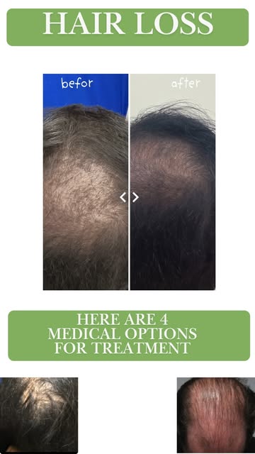 Struggling with thinning hair? You have options. 🌿✨

Hair loss happens for different reasons, which