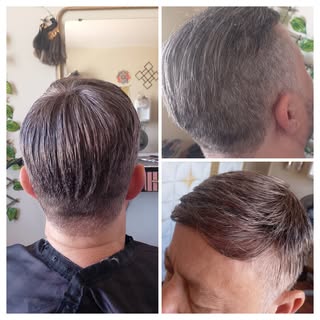 Prótese capilar o cabelo que cobre a calvície