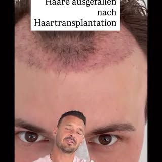 Die Shedding-Phase ist ganz normal. 🌱

Nach einer Haartransplantation fallen die transplantierten H