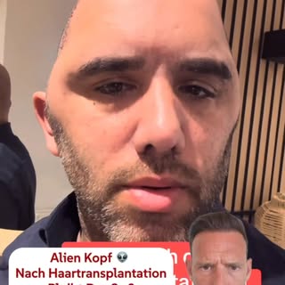 ⚠️ Keine Sorge – das kann nach einer Haartransplantation vorkommen.

Wenn in den ersten 3 Tagen der 