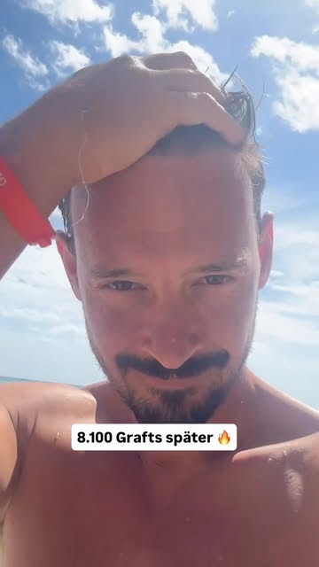 Früher hätte mich der Wind am Meer gestört.

Heute spiele ich damit. 🌊 😉

#haartransplantation #ha