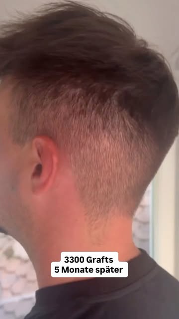 Der Heilungsprozess vom Donorbereich verläuft meist schneller als die Haare anwachsen.

Was meint ih