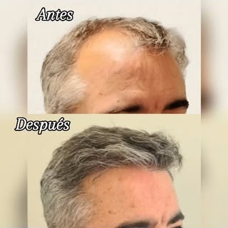 Resultado de #microinjertocapilar tras 6 meses de intervención. El resultado del trasplante Capilar 