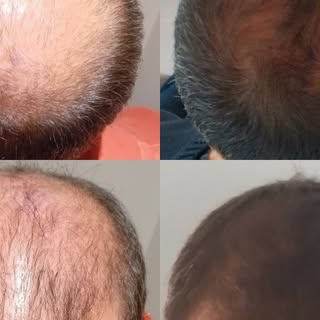 Paciente a quien se le realizó tratamiento médico de la alopecia con #dutasteride, #minoxidil y #mes