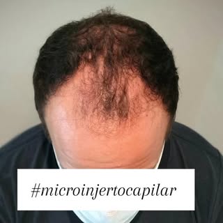 #trasplantecapilarfue #microinjertocapilar #trasplantedepelo #cirugiaesteticafacial #pelazo #alopeci