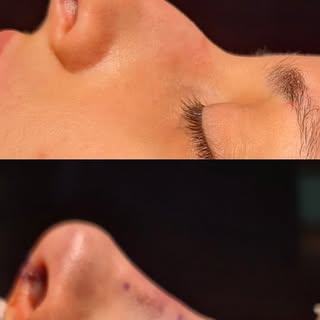 La #RINOPLASTIA es la cirugía que nos permite modificar la forma de la nariz, mediante la #Rinoplast