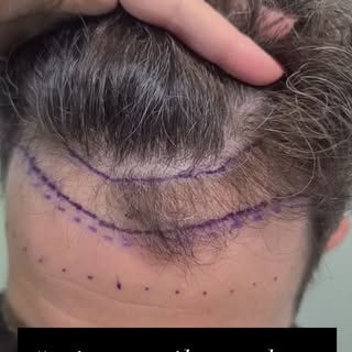Microinjerto capilar NO SHAVE.  Cerramos la primera línea con una alta densidad para crear ese efect