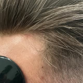 Hair replacement looking amazing!! #imagedesignstudio
#Lasertherapy 
#Essex
#hairlosstreatmentformen