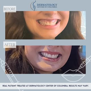 We love before and after photos!
Patient was treated with Dysport for a lip flip and a gummy smile! 
