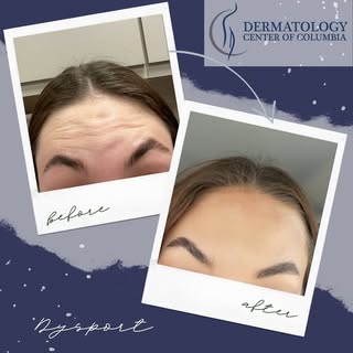 Before and After of Dysport ✨
The first picture was taken the day of treatment, while the second pic