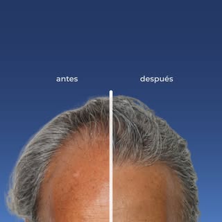 El arte de que no se note.
​Un trasplante exitoso no es solo poner cabello, es diseñar una línea fro