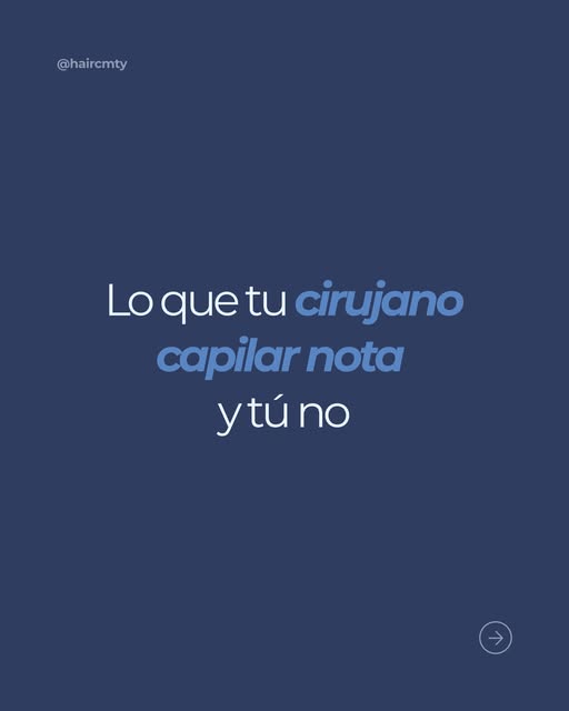 Lo difícil no es poner cabello. Lo difícil es que nadie note que fue trasplantado.

📱  81 8378 0866