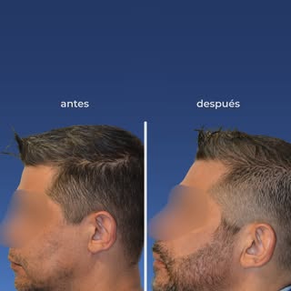 El trasplante de barba es un procedimiento capilar avanzado en el que se extraen folículos pilosos —