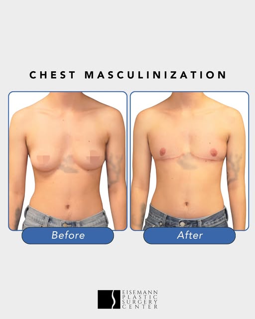 Healing in progress, confidence on the rise. 🤩

At one month post-op, this patient shows a flatter,