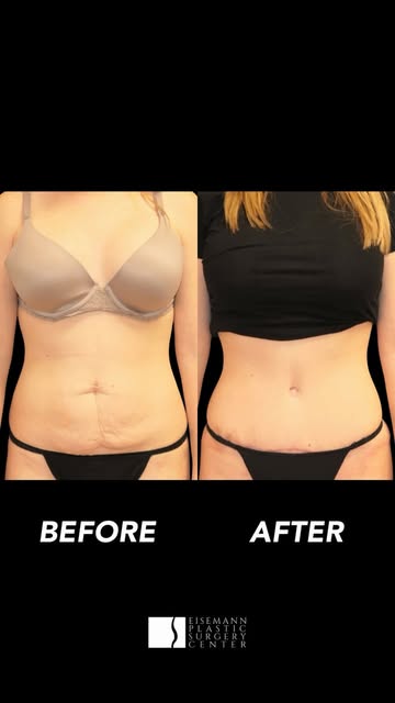 6 months post-op and loving her results.🤍

This 27-year-old patient underwent a tummy tuck to addre