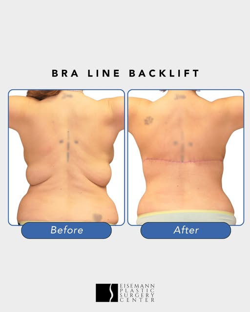 Confidence from every angle. ✨

This before-and-after bra line backlift result showcases the removal