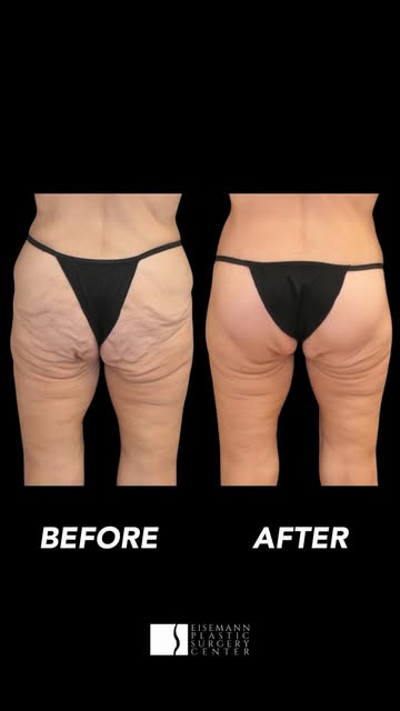 Excess skin removed. ✨

This patient underwent a posterior body lift with buttock augmentation, a pr