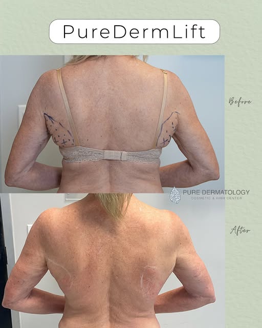 Introducing PureDermLift, my custom treatment designed specifically for loose, crepey skin along the