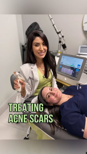Acne scars can be stubborn, especially when we’re dealing with deeper ice pick and boxcar scarring.⚡