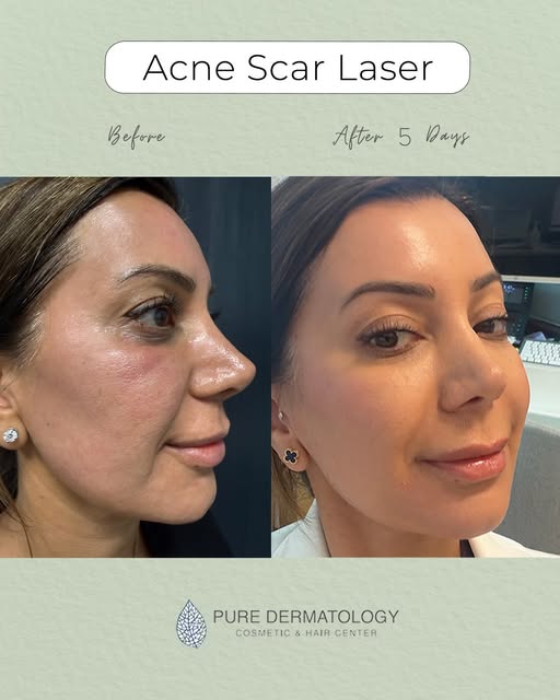 She is GLOWING just 5 days after her acne scar laser treatment and already seeing a smoother, more r