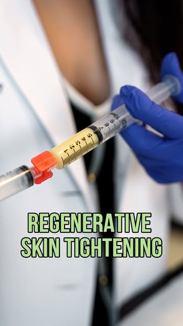 We’re combining the body’s own growth factors with Radiesse, a biostimulatory filler I love for supp