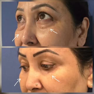 Showing his result after 2 weeks of Lower Eyelid Blepharoplasty +Mid-Face Lift. Patient looked 10 ye