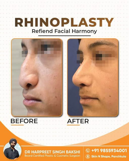 Natural looking results, shaped with precision and balance. ✨

📍Skin N Shape, Panchkula
📞 +91 9855