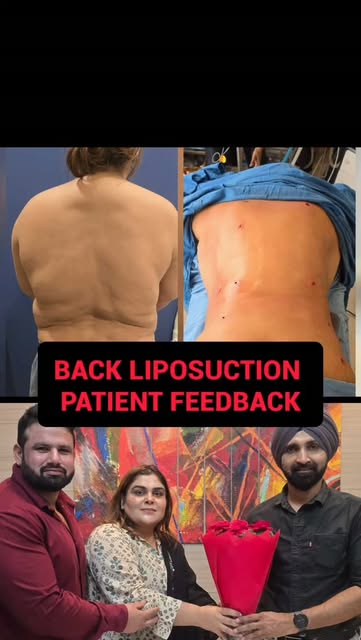 Sharing Feedback of this Patient who underwent High-definition Liposuction Of the Back Area and had 