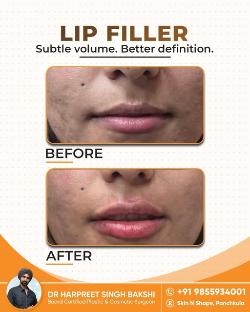 Subtle volume, better definition, lip filler designed to complement your natural features.

📍Skin N