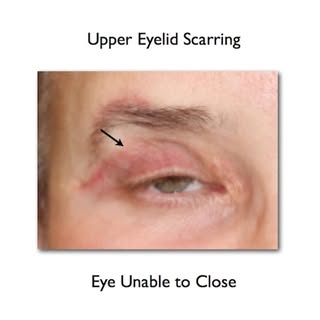 Upper Eyelids Can't Close after Blepharoplasty? The Dos and Don'ts #Blepharoplasty #uppereyelidsurge