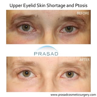 Eyes Won't Close After Blepharoplasty? Misdiagnosed Drooping & Revision #eyescantclose #blepharoplas