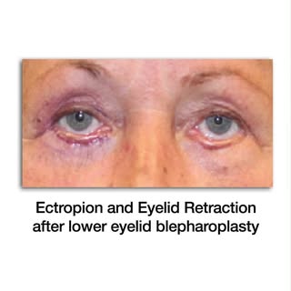 Eyelid Specialist: Risks of Lower Lid Skin Removal #wrinkles #undereyewrinkles #wrinkletreatment #bl