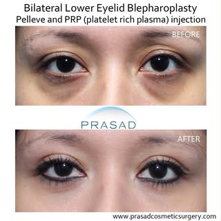 Lower Eyelid Surgery Complications How I Avoid Them #eyelidsurgery #blepharoplasty #eyebags #eyebags