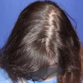 Is PCOS Behind Your Hair Thinning? #hairloss #womenshairloss #hairthinning #femalehairthinning #pcos