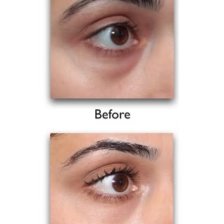 Filler can Hide Under Eye Bags...Sometimes #eyebags #eyebagremoval #puffyeyes #eyebagstreatment #eye